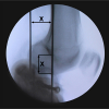 Fijador-externo-articulado3