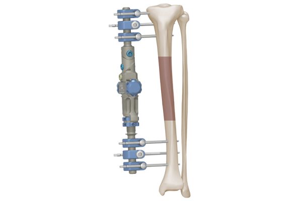 fijador-externo-femur3
